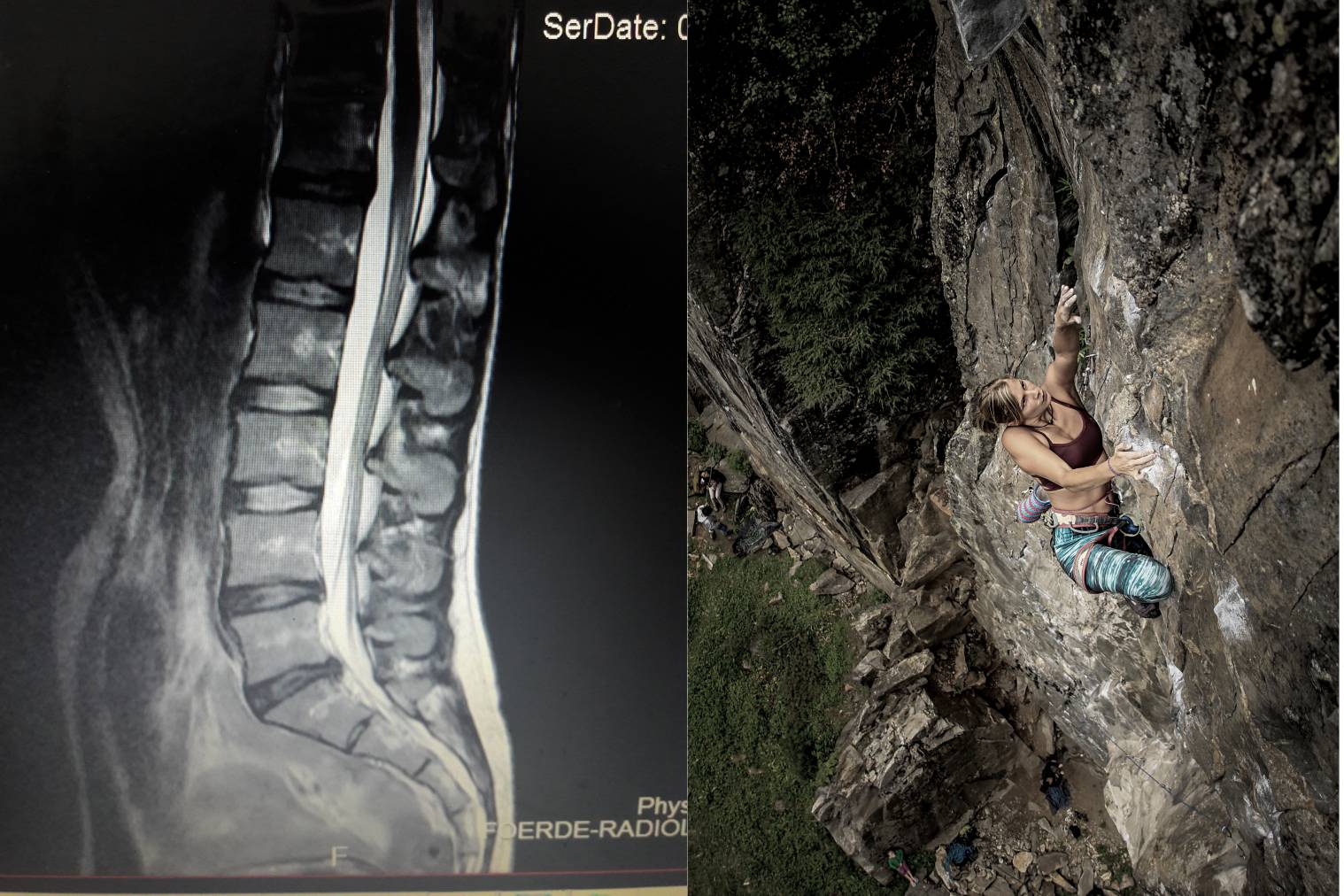 geteiltes Bild MRT Aufnahme Rücken und Frau beim Klettern